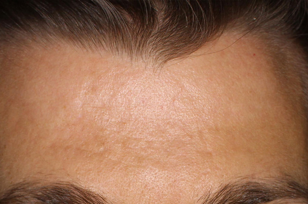 Mans forehead - After essential moisture boost