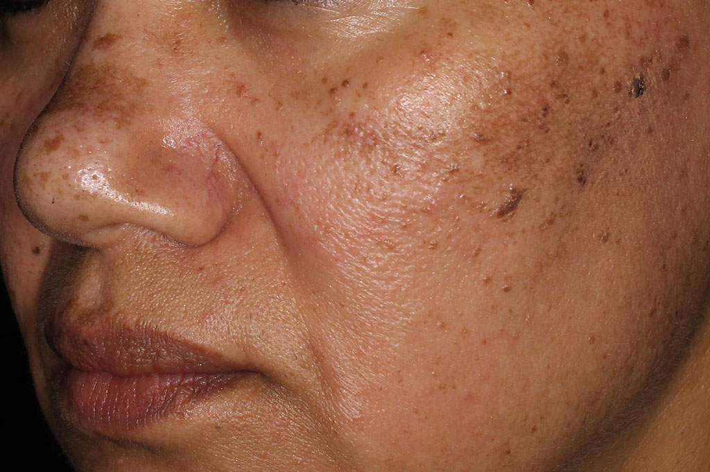 Woman side of face - after Environ focus on even tone