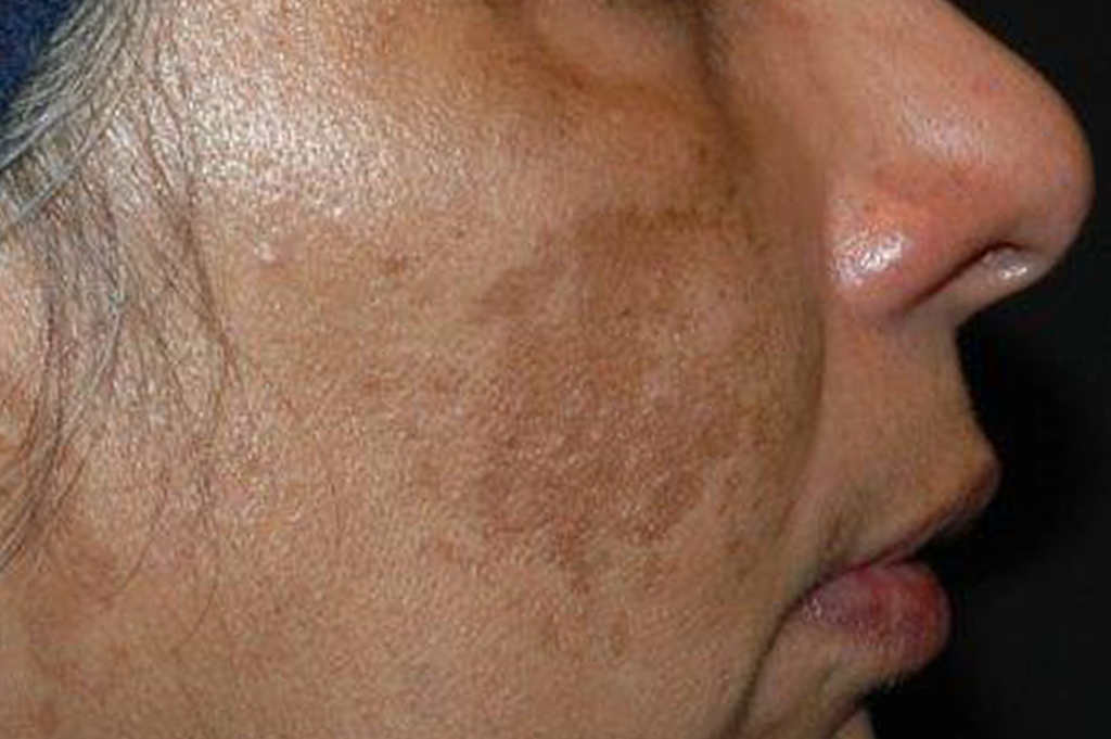 Skin Pigmentation Results Environ Skin Care South Africa